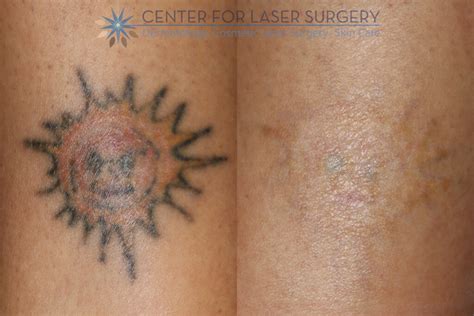 tattoo removal philippines|Tattoo Removal .